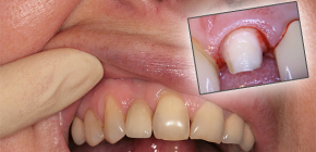 What to do if a tooth hurts under the crown