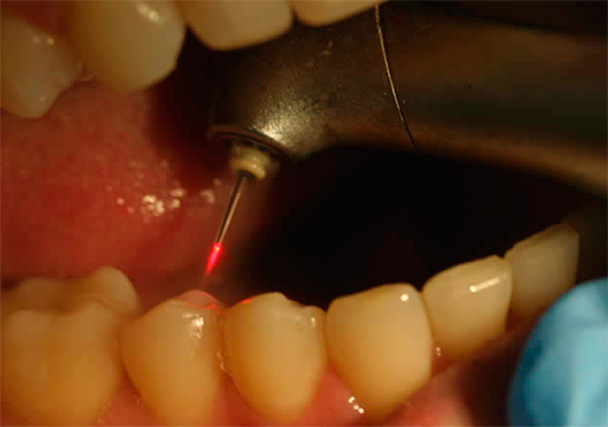 Η χρήση ενός λέιζερ στην οδοντιατρική θεραπεία μπορεί επίσης να μειώσει σημαντικά τον πόνο από τη διαδικασία.