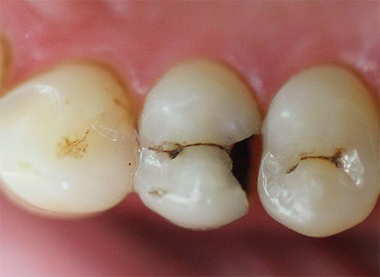 With deep caries and the absence of anesthesia, treatment can be very painful ...