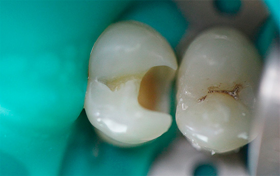Dalam kes sedemikian, doktor perlu membersihkan dentin yang dijangkiti ke kedalaman yang besar (satu contoh ditunjukkan dalam foto)