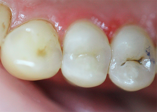 And it looks like an already filled tooth after treatment