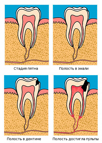 Etapa dezvoltării cariilor: de la un loc pe dinte până la înfrângerea camerei pulpare.