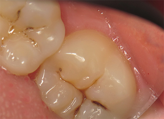 The photo shows a typical example of fissure caries.