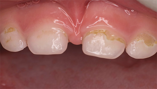 O caracteristică caracteristică a cariilor din sticle este înfrângerea simultană a mai multor dinți simultan.