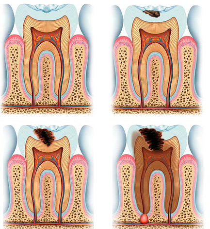 Лечење дубоког каријеса може бити компликовано због близине инфицираног ткива у пулпној комори зуба.