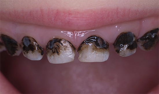 An example of teeth after silvering is shown - you must agree that they do not look very beautiful.