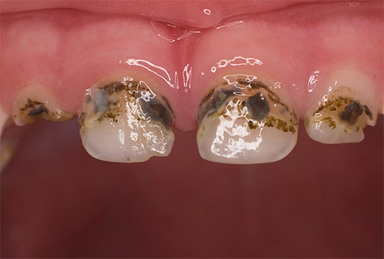 Generelt kan det bemerkes at effektiviteten av sølvfarging av tenner for å forhindre utvikling av karies er ganske tvilsom.