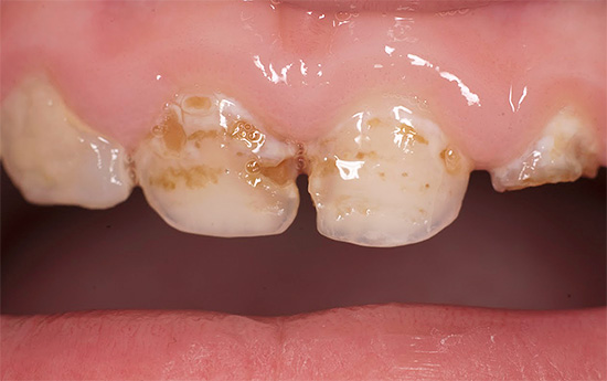 А ово је дубљи кариозни процес: зубна цаклина је на месту потпуно уништена.