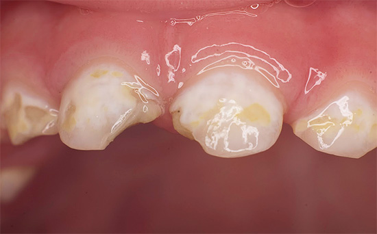 Каријес боца са листопадним зубима пре третмана