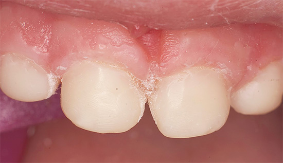 Et donc les mêmes dents ressemblent, mais après le traitement.