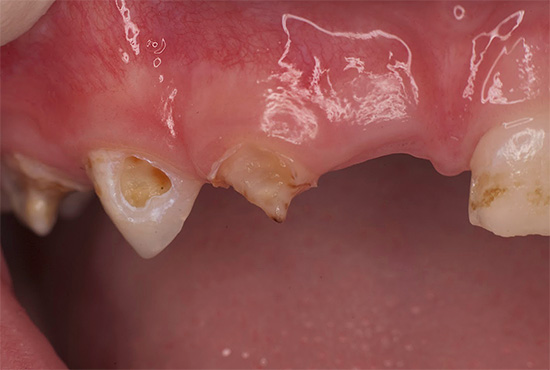 Opomíjená forma zubního kazu u dítěte je často vinou jeho rodičů, kteří se díky své nečinnosti dostali do takové situace.
