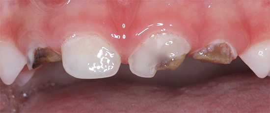 In het late ontwikkelingsstadium van cariës op flessen, wordt een aanzienlijk deel van het glazuur en het dentine van de tand volledig vernietigd.