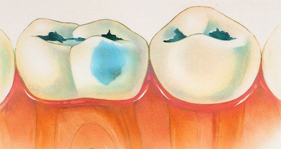 อันตรายมากและมักจะเกี่ยวข้องกับภาวะแทรกซ้อนต่าง ๆ เป็นหลักสูตรของฟันผุในรูปแบบ decompensated ...