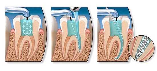 Când se tratează o formă decompensată de carii, este deseori necesară efectuarea depulpării (îndepărtarea nervului dentar)