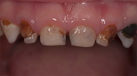 A characteristic sign of the decompensated form of caries is the defeat of many teeth at once, and the degree of destruction can be from mild to almost complete absence of hard tissues.