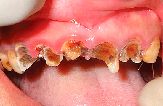 I akutte karies kan tennene bli alvorlig skadet på bare noen få uker.