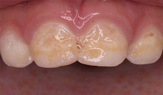 Numerosas lesiones cariosas del esmalte dental indican claramente un problema grave y la necesidad de consultar urgentemente a un dentista.
