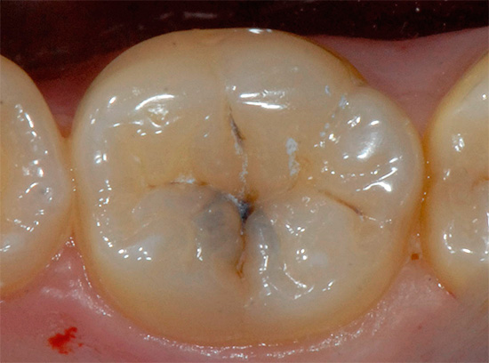 Minsan, ang fissurotomy ay ginagamit upang masuri ang lalim ng carious cavities.
