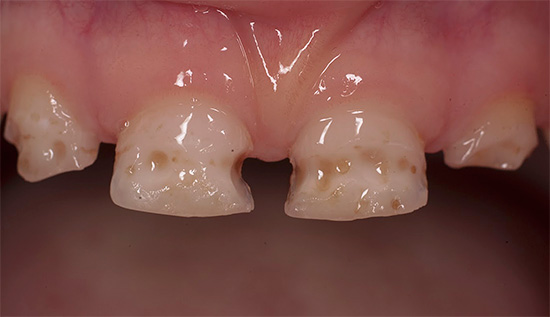 Acute caries most often develops in children with milk teeth