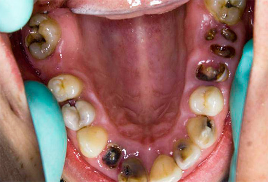 The photo shows an example when almost all teeth are affected by caries.