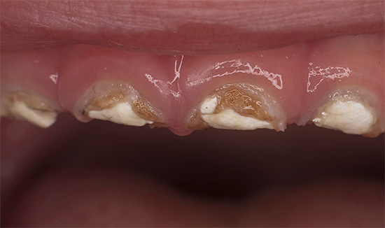 Fotoattēlā parādīts bojātu zobu samazinājuma piemērs pirms atjaunošanas.