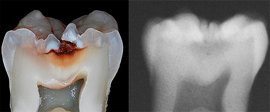 Een röntgenfoto kan alleen cariës in het fissuurgebied detecteren in de latere stadia, wanneer het tandweefsel al ernstig is vernietigd.