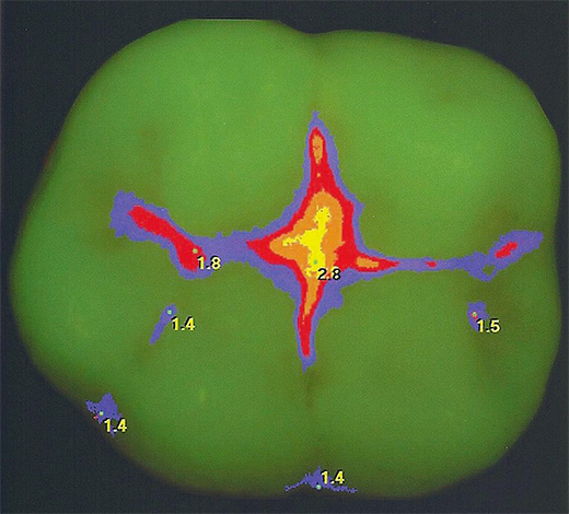 Een van de zeer effectieve moderne methoden voor het detecteren van cariës in de spleet is laserdiagnostiek.