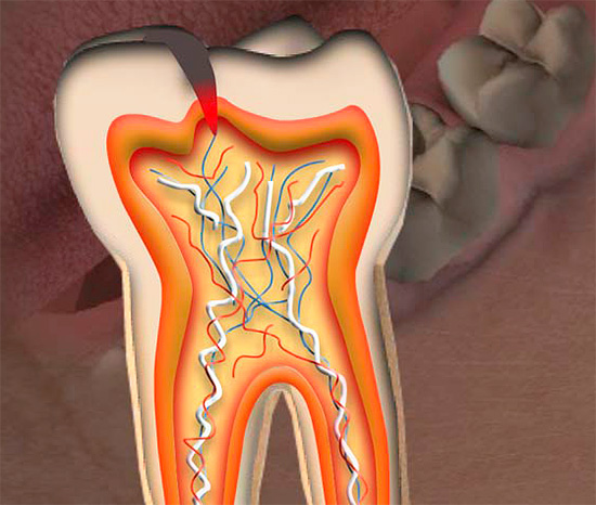 หากรอยแยกของฟันผุมาถึงห้องเยื่อกระดาษในกรณีส่วนใหญ่จำเป็นต้องถอนเส้นประสาททันตกรรมออก