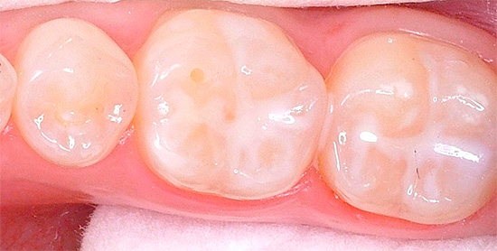 La foto mostra i denti con fessure sigillate.
