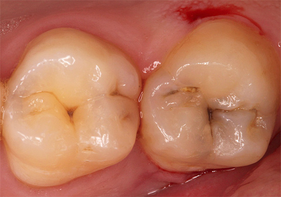 La carie delle fessure si trova principalmente nella parte centrale del dente, sebbene ci siano spesso delle eccezioni.