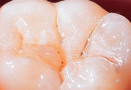 In de meeste gevallen ontwikkelt fissuurcariës zich asymptomatisch, hoewel je door in de spiegel te kijken al de donkere gebieden op de tanden kunt zien.