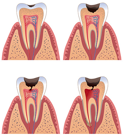 Bolest může začít, když se zubní proces dostane k dentinu a zejména k vlákniny.