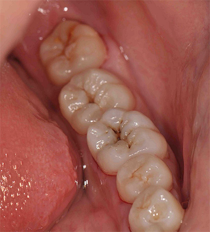 Sovint es pot detectar càries amb fissures, fins i tot amb un simple examen visual de les dents.