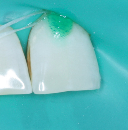Der Zahn wird mit einem Kofferdam von der Mundhöhle isoliert, ICON wird auf den Zahnschmelz aufgetragen.