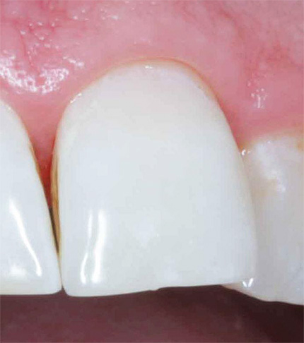 И така изглежда зъб след лечение с помощта на технологията ICON