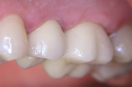 Med korrekt förebyggande av karies hemma är det möjligt att på ett tillförlitligt sätt skydda tänderna från förfall.