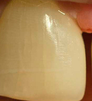 Πολύ ζεστά και κρύα προϊόντα συμβάλλουν στην εμφάνιση μικροκονιών στο σμάλτο των δοντιών.