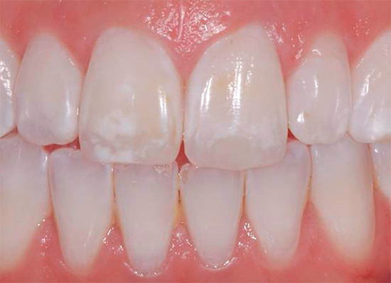 Dans certains cas, l'utilisation de dentifrices fluorés à la maison peut être nocive, par exemple, avec une fluorose (des taches blanches apparaissent sur les dents en raison d'un excès de cet élément dans le corps).