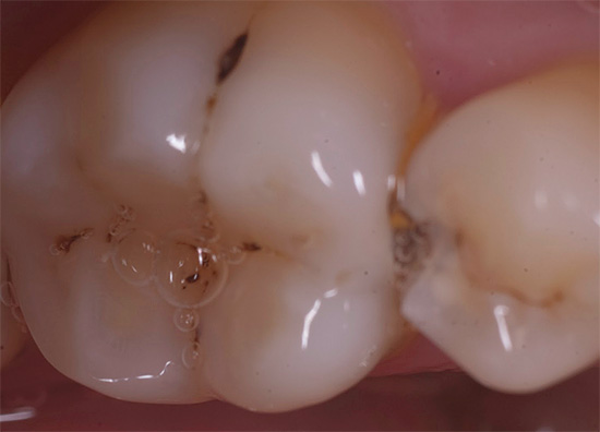 Hlboko pigmentovanú sklovinu môže odstrániť iba zubný lekár, po ktorej nasleduje vyplnenie zubov.