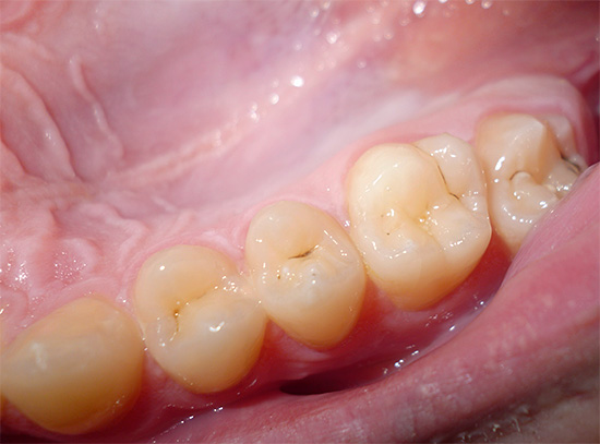 Das Foto zeigt eine typische kariöse Bräunung im Fissurenbereich des Zahns - es ist fast unmöglich, sie zu Hause zu entfernen.