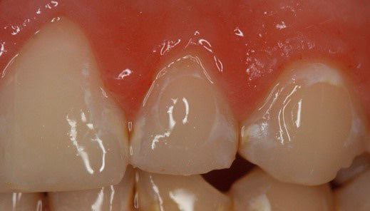 A tu je zubný kaz zobrazený v počiatočnej fáze tzv. Bielej škvrny, takže je celkom možné proti nemu bojovať.