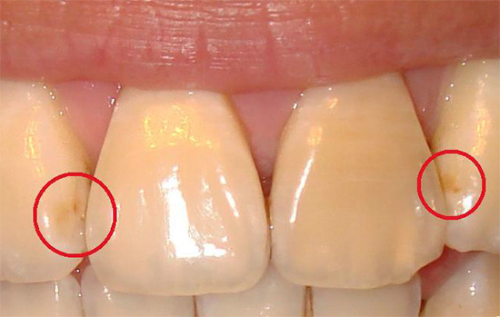 Am leichtesten sind die ersten Anzeichen von Karies an den Vorderzähnen zu erkennen (das Beispiel zeigt pigmentierten Zahnschmelz, der durch allmähliche Demineralisierung porös geworden ist).