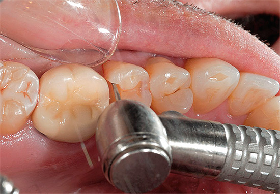 If you miss a moment and do not heal caries in the initial stage in time, you will inevitably have to put a seal ...