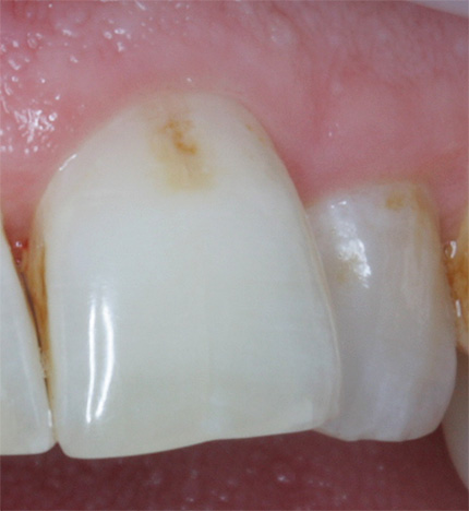 Kuvassa on esimerkki hammasta, jolla on alustava karies ennen hoitoa.