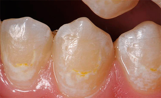 La foto mostra un exemple de càries inicial: l’esmalt de dents es va tornar blanc i va començar a pigmentar-se.