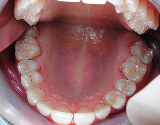 การปรากฏตัวของเศษอาหารในระยะยาวเป็นประจำในช่องปากเป็นสื่อที่ดีสำหรับการแพร่กระจายของแบคทีเรีย cariogenic