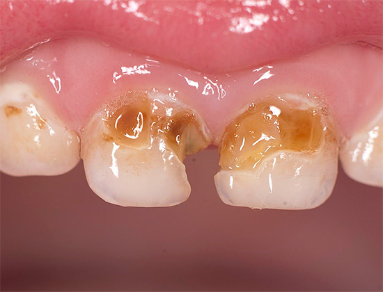 Die folgenden Methoden zum Schutz Ihrer Zähne sind besonders nützlich für diejenigen, die bereits kariöse Läsionen haben und ihre Entwicklung stoppen möchten.