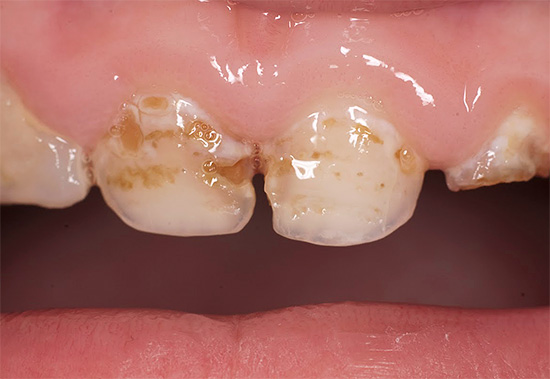 Avec une mauvaise hygiène buccale, l'émail dentaire peut être détruit dans certains cas très rapidement, en particulier dans les dents primaires.