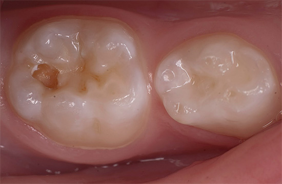 Etter ødeleggelse av emalje sprer karies seg til tannens tann, og diagnosen patologi og etterfølgende behandling på dette stadiet har sine egne egenskaper ...