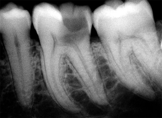 Sairaan hampaan röntgenkuvaus: dentiini ja massa ovat näkyvissä